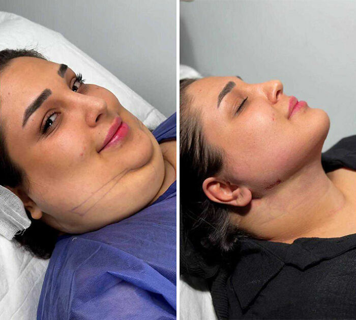 31 Impressive Jawline Transformations Shared On This Page Have People Doing A Double Take