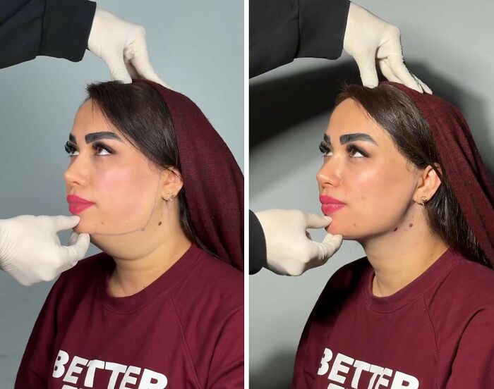 31 Impressive Jawline Transformations Shared On This Page Have People Doing A Double Take