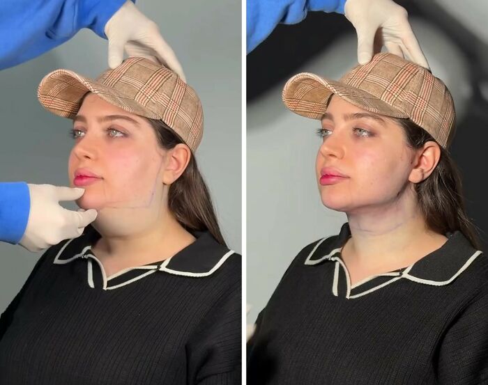 31 Impressive Jawline Transformations Shared On This Page Have People Doing A Double Take
