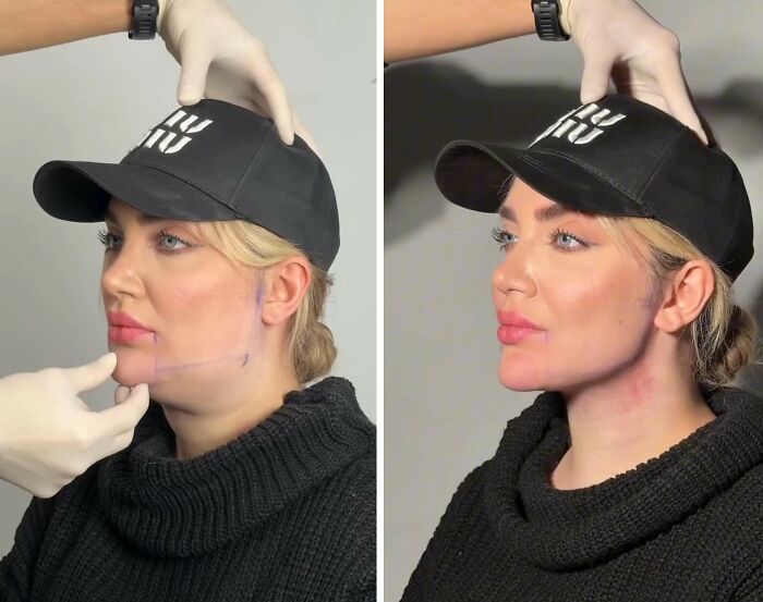 31 Impressive Jawline Transformations Shared On This Page Have People Doing A Double Take