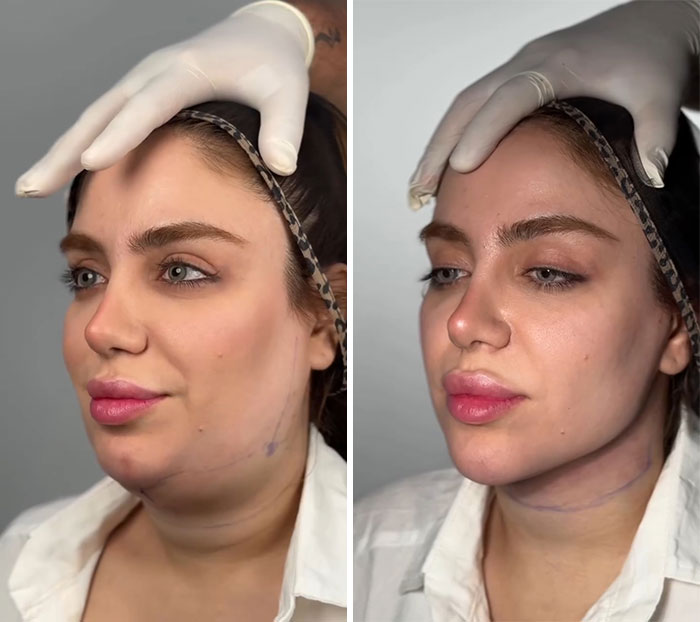 31 Impressive Jawline Transformations Shared On This Page Have People Doing A Double Take