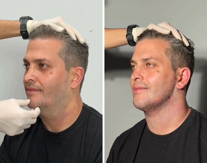 31 Impressive Jawline Transformations Shared On This Page Have People Doing A Double Take