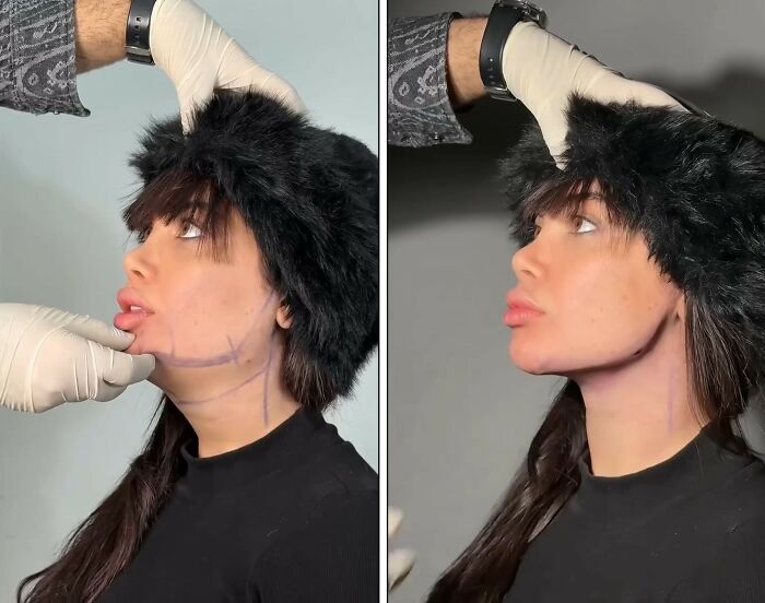 31 Impressive Jawline Transformations Shared On This Page Have People Doing A Double Take