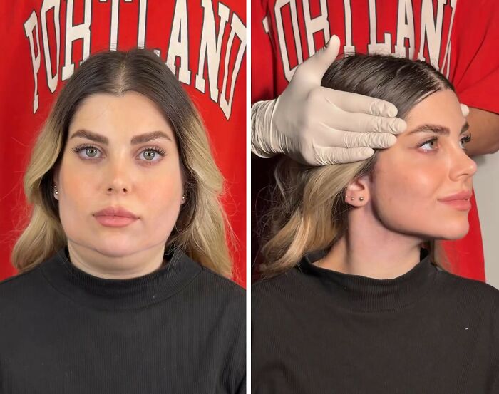 31 Impressive Jawline Transformations Shared On This Page Have People Doing A Double Take