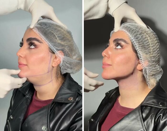 31 Impressive Jawline Transformations Shared On This Page Have People Doing A Double Take