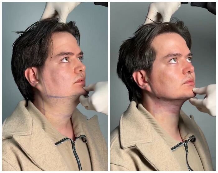 31 Impressive Jawline Transformations Shared On This Page Have People Doing A Double Take