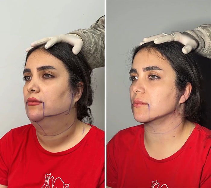 31 Impressive Jawline Transformations Shared On This Page Have People Doing A Double Take