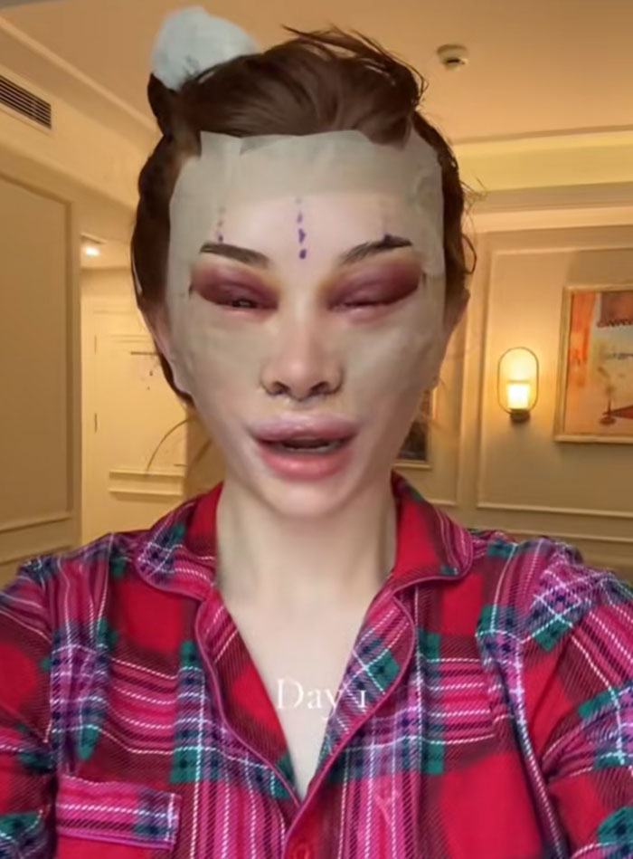 &ldquo;Ridiculously Sad&rdquo;: 28YO Woman&rsquo;s Facelift Sparks Raging Debate As People Question Society&rsquo;s New Normal