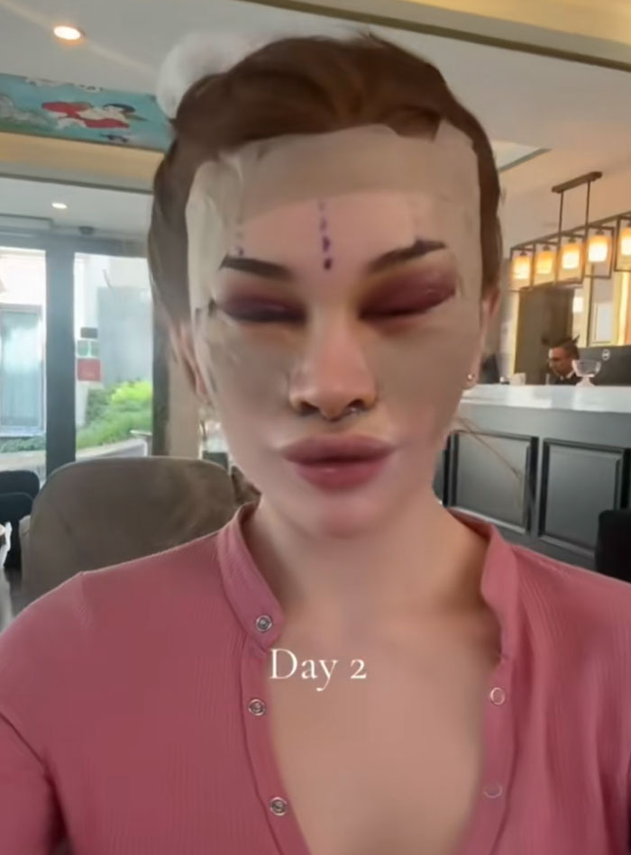 &ldquo;Ridiculously Sad&rdquo;: 28YO Woman&rsquo;s Facelift Sparks Raging Debate As People Question Society&rsquo;s New Normal