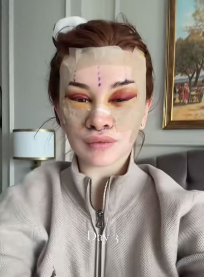 &ldquo;Ridiculously Sad&rdquo;: 28YO Woman&rsquo;s Facelift Sparks Raging Debate As People Question Society&rsquo;s New Normal