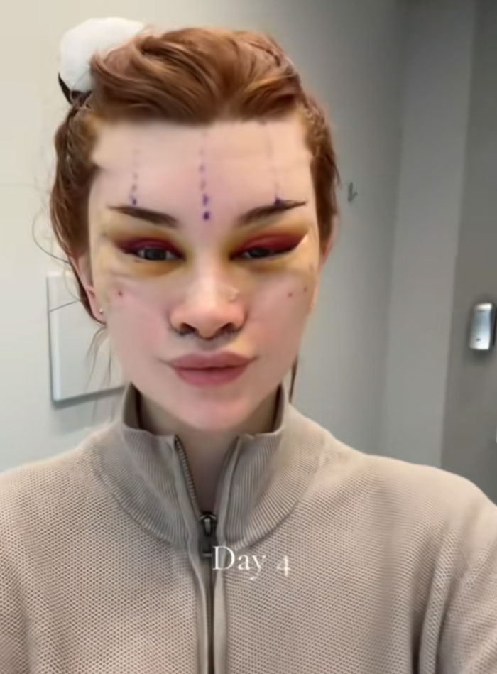 &ldquo;Ridiculously Sad&rdquo;: 28YO Woman&rsquo;s Facelift Sparks Raging Debate As People Question Society&rsquo;s New Normal