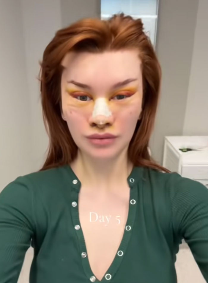 &ldquo;Ridiculously Sad&rdquo;: 28YO Woman&rsquo;s Facelift Sparks Raging Debate As People Question Society&rsquo;s New Normal