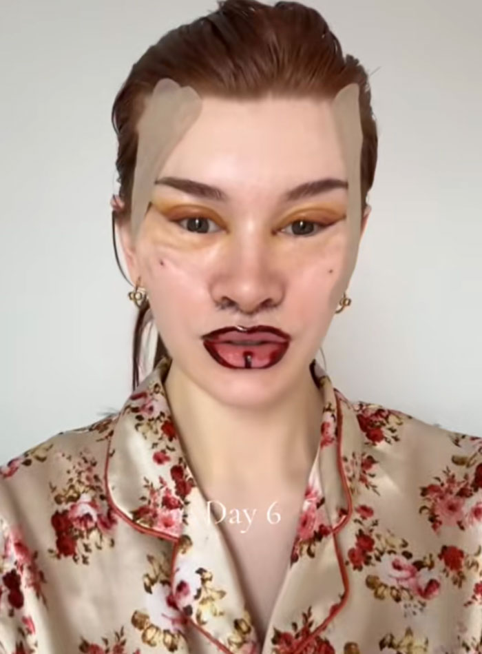 &ldquo;Ridiculously Sad&rdquo;: 28YO Woman&rsquo;s Facelift Sparks Raging Debate As People Question Society&rsquo;s New Normal