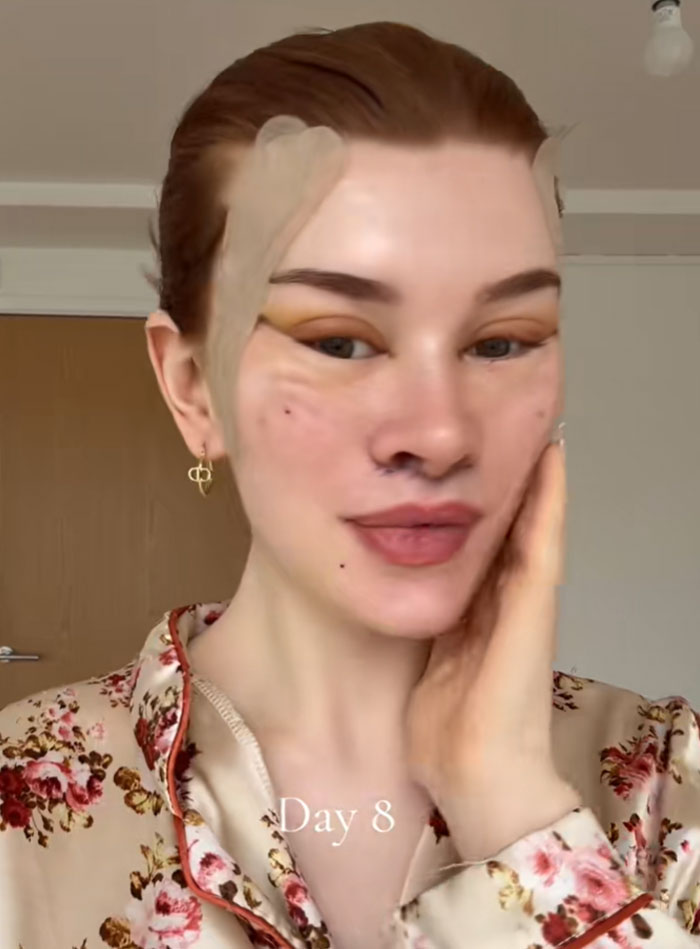 &ldquo;Ridiculously Sad&rdquo;: 28YO Woman&rsquo;s Facelift Sparks Raging Debate As People Question Society&rsquo;s New Normal