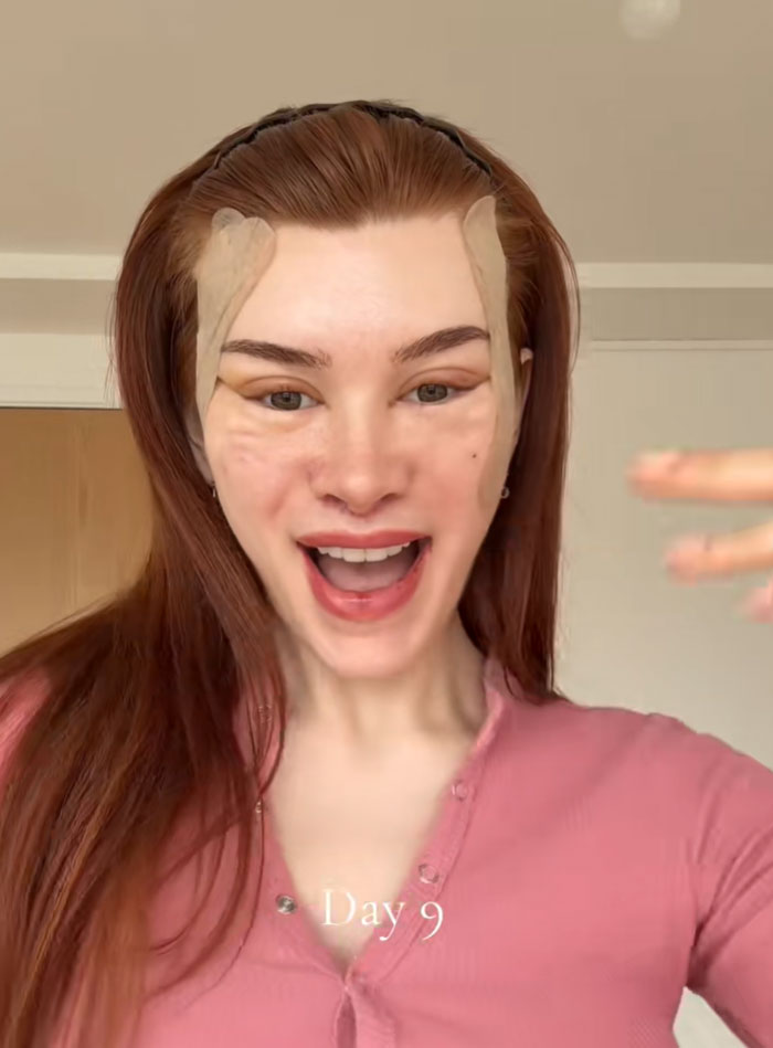 &ldquo;Ridiculously Sad&rdquo;: 28YO Woman&rsquo;s Facelift Sparks Raging Debate As People Question Society&rsquo;s New Normal