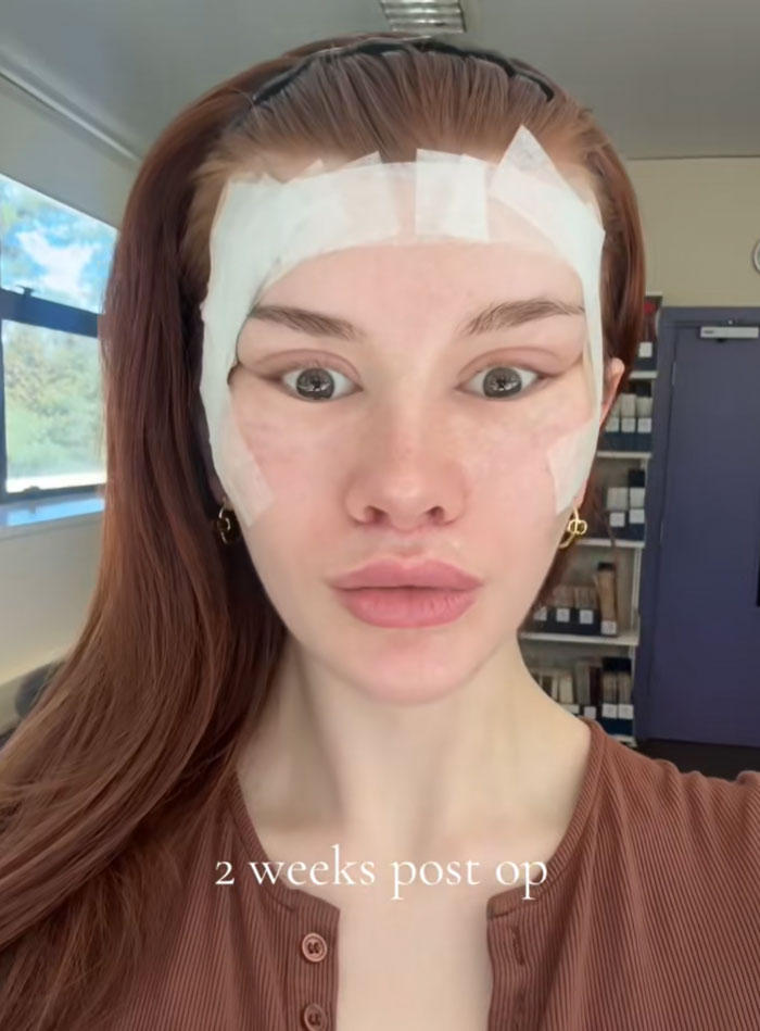 &ldquo;Ridiculously Sad&rdquo;: 28YO Woman&rsquo;s Facelift Sparks Raging Debate As People Question Society&rsquo;s New Normal