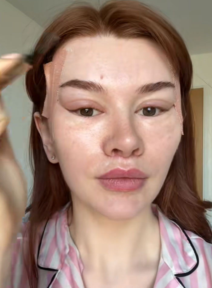 &ldquo;Ridiculously Sad&rdquo;: 28YO Woman&rsquo;s Facelift Sparks Raging Debate As People Question Society&rsquo;s New Normal