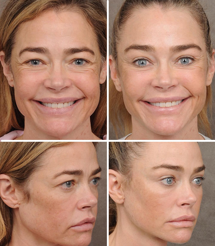 15 Times Celebrities And Influencers Shared Their Plastic Surgery Results Openly