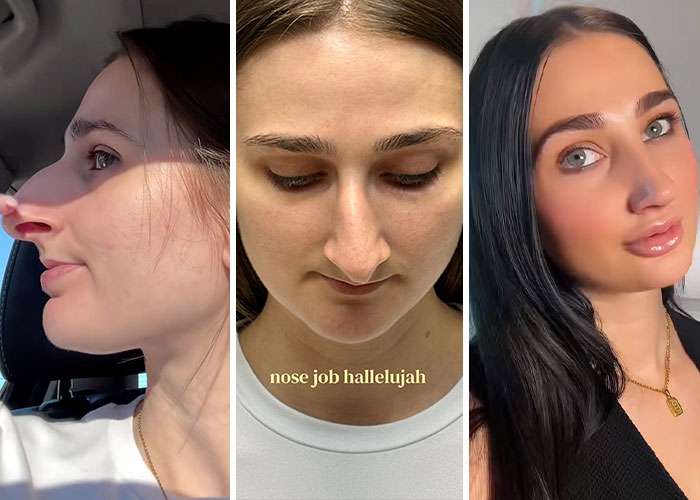 15 Times Celebrities And Influencers Shared Their Plastic Surgery Results Openly