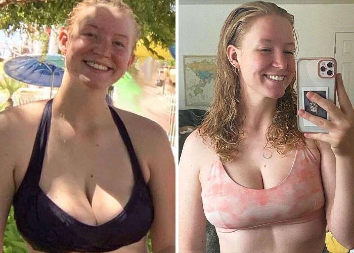 15 Times Celebrities And Influencers Shared Their Plastic Surgery Results Openly