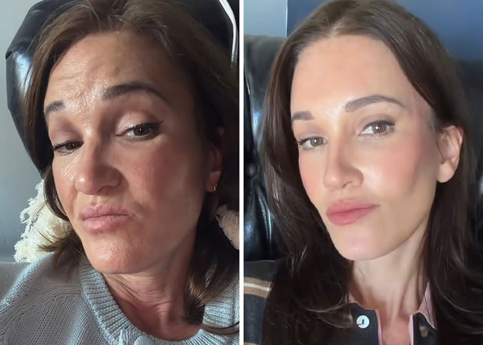 15 Times Celebrities And Influencers Shared Their Plastic Surgery Results Openly