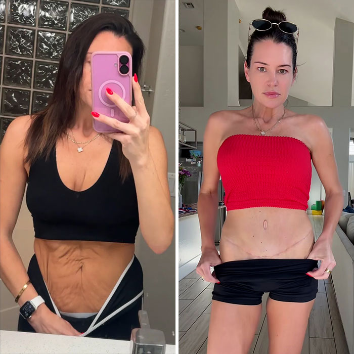 15 Times Celebrities And Influencers Shared Their Plastic Surgery Results Openly