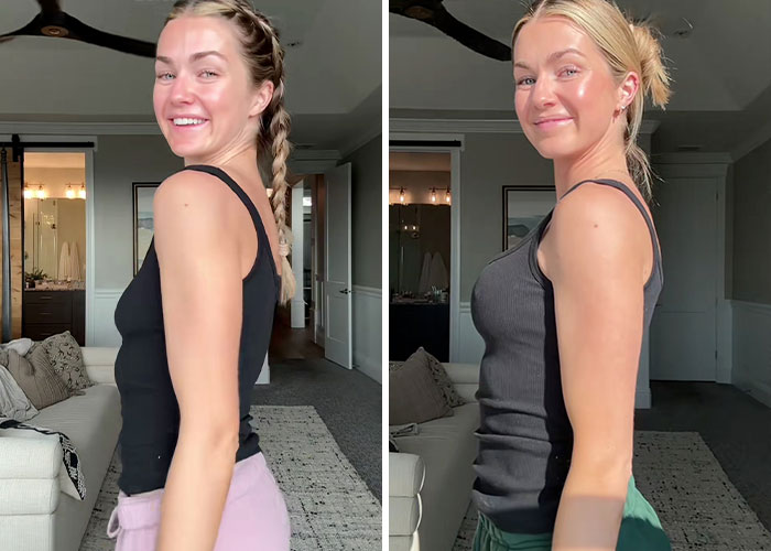 15 Times Celebrities And Influencers Shared Their Plastic Surgery Results Openly