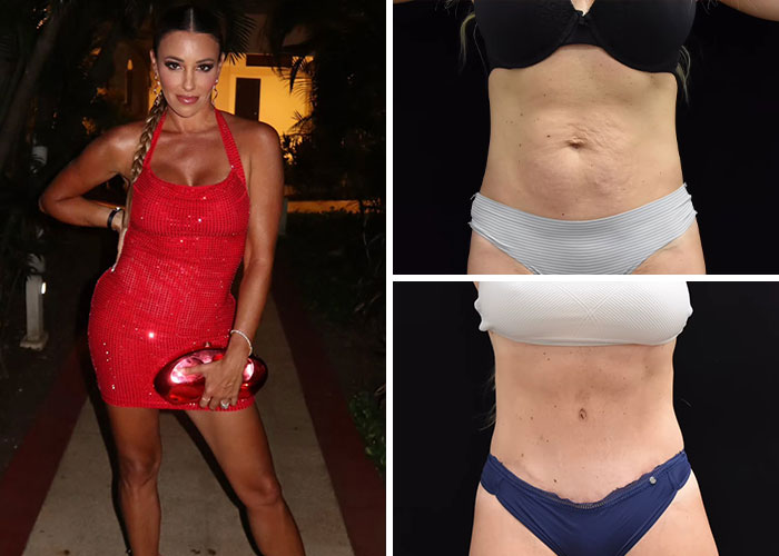 15 Times Celebrities And Influencers Shared Their Plastic Surgery Results Openly
