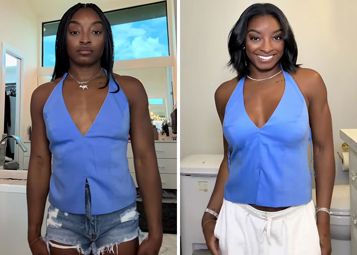 15 Times Celebrities And Influencers Shared Their Plastic Surgery Results Openly