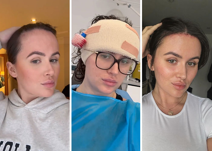 15 Times Celebrities And Influencers Shared Their Plastic Surgery Results Openly