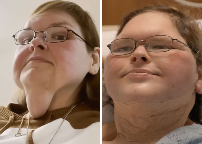 15 Times Celebrities And Influencers Shared Their Plastic Surgery Results Openly