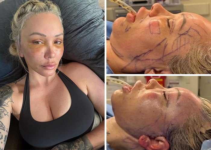 15 Times Celebrities And Influencers Shared Their Plastic Surgery Results Openly