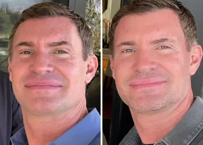 15 Times Celebrities And Influencers Shared Their Plastic Surgery Results Openly