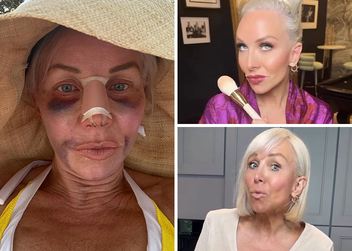15 Times Celebrities And Influencers Shared Their Plastic Surgery Results Openly