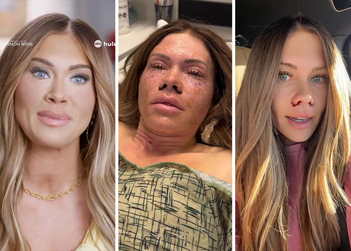 15 Times Celebrities And Influencers Shared Their Plastic Surgery Results Openly