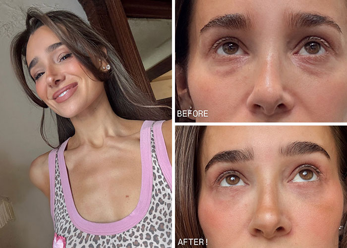 15 Times Celebrities And Influencers Shared Their Plastic Surgery Results Openly