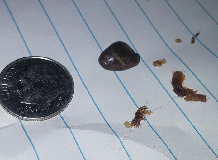 Guy Carries A Rock In His Ear For 13 Years, Finally Pulls It Out Himself After Doctors Fail