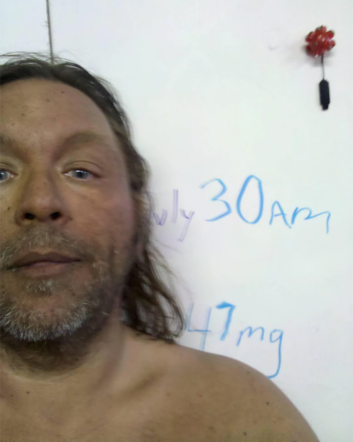 “Breaking New Ground”: Man Reveals Results After Injecting Himself With Unregulated Tanning Peptide Melanotan 2