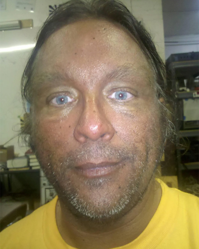 “Breaking New Ground”: Man Reveals Results After Injecting Himself With Unregulated Tanning Peptide Melanotan 2