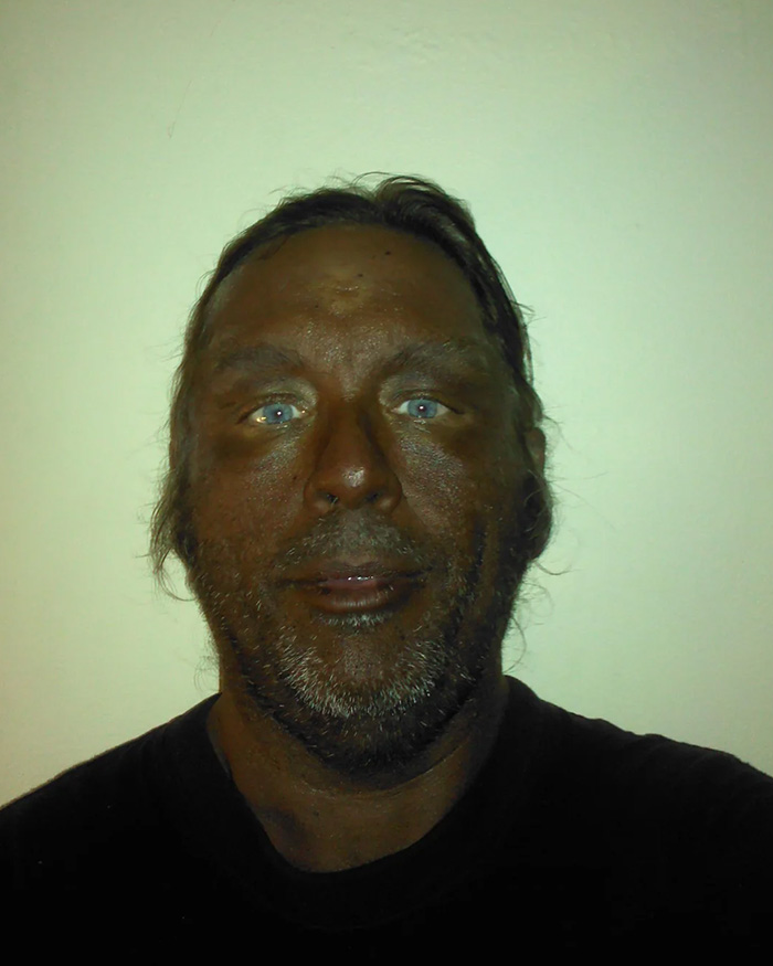 “Breaking New Ground”: Man Reveals Results After Injecting Himself With Unregulated Tanning Peptide Melanotan 2
