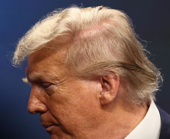 White House Accused Of Concealing Trump’s Medical History After Truth About Hair-Loss Treatment Discovered