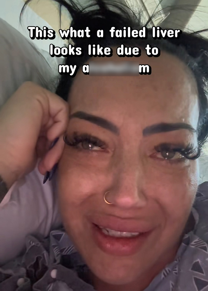“Your Sign To Stop Now”: Woman’s Story Stuns As She Shares Experience With Liver Failure Due To Drinking
