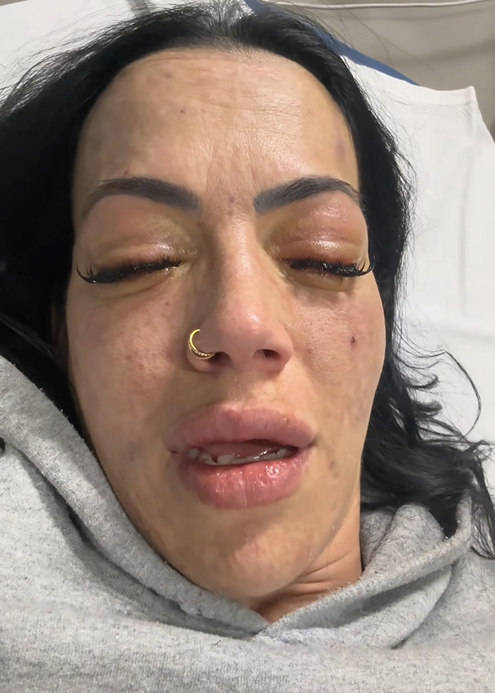 “Your Sign To Stop Now”: Woman’s Story Stuns As She Shares Experience With Liver Failure Due To Drinking
