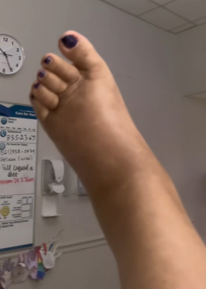 “Your Sign To Stop Now”: Woman’s Story Stuns As She Shares Experience With Liver Failure Due To Drinking