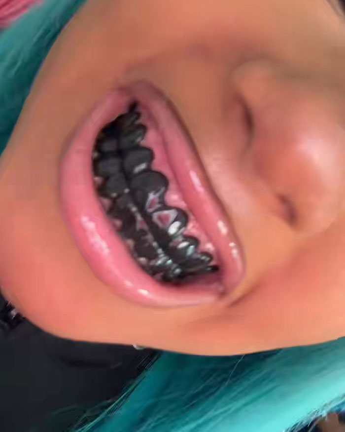 After North West Debuts ‘Blackened Teeth,’ Experts Reveal What Many People Don’t Know About Black Grills