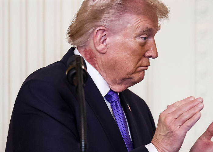 Following Trump’s Abrupt Interview Exit, Health‑Related Observations Surface Among Viewers Following Trump’s Abrupt Interview Exit, Health‑Related Observations Surface Among Viewers