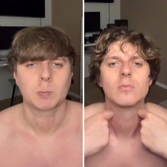 Man Reveals Dramatic 80-Day Transformation After Daily Jaw Exercises Man Reveals Dramatic 80-Day Transformation After Daily Jaw Exercises