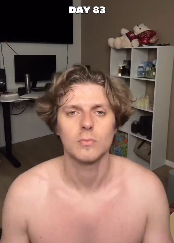 Man Reveals Dramatic 80-Day Transformation After Daily Jaw Exercises Man Reveals Dramatic 80-Day Transformation After Daily Jaw Exercises