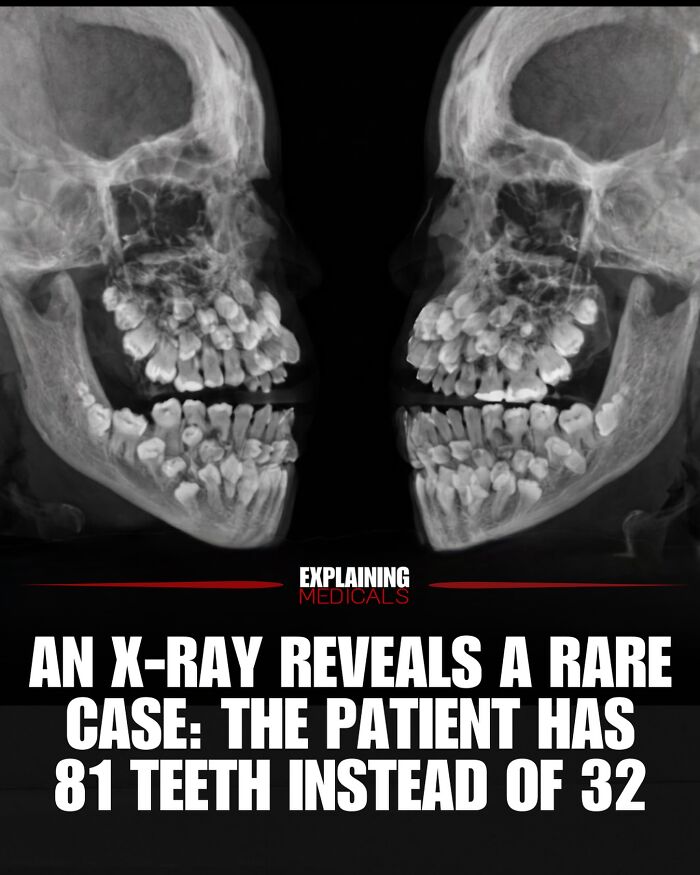 &ldquo;The Patient Has 81 Teeth&rdquo;: 61 Facts About Health And The Human Body That Show Just How Strange We Really Are