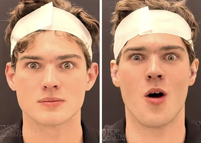 “Looksmaxxing” Attempt By Clavicular Torn Down By Netizens After He Shared Side-By-Side Results